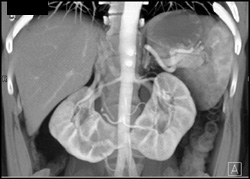 Horseshoe Kidney - CTisus CT Scan