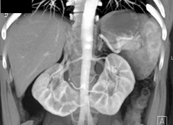 Horseshoe Kidney - CTisus CT Scan