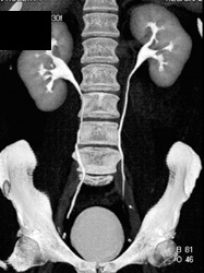 Ct Urogram - CTisus CT Scan