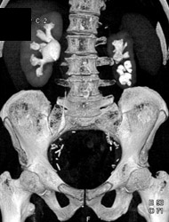 Right Hydronephrosis on CT Urogram - CTisus CT Scan