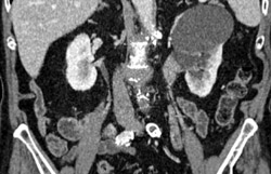 Renal Cysts and Transitional Cell Cancer (TCC) Left Renal Pelvis - CTisus CT Scan