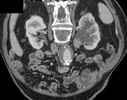 Transitional Cell Carcinoma in Left Renal Pelvis - CTisus CT Scan