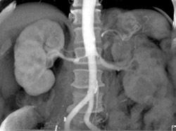 Prehilar Branching of Right Renal Artery and Ras - CTisus CT Scan