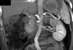 Stent in Left Renal Artery - CTisus CT Scan