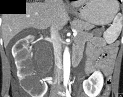 Trauma to Right Kidney Which Had An Incidental Ureteropelvic Junction (UPJ) - CTisus CT Scan