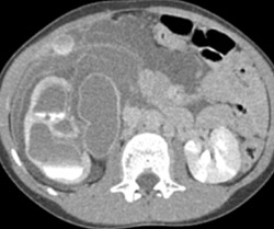 Trauma to Ureteropelvic Junction (UPJ) in Right Kidney - CTisus CT Scan