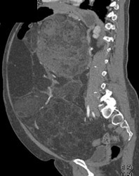 Liposarcoma - CTisus CT Scan