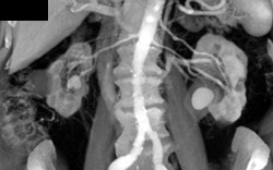 Bilateral Slaghorn Calculi - CTisus CT Scan