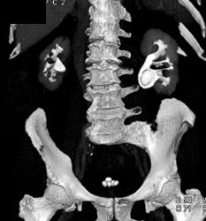 Slaghorn Calculi - CTisus CT Scan