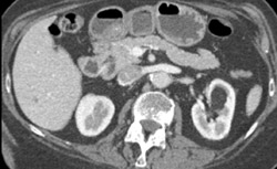 Left Renal Angiomyolipoma (AML) - CTisus CT Scan