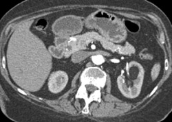 Angiomyolipoma (AML) Left Kidney - CTisus CT Scan