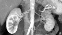 Prehilar Branching on the Right - CTisus CT Scan