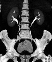 Duplicated Collecting System on the Right - CTisus CT Scan