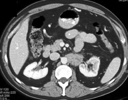 Pancreatic Cancer Encases the Left Renal Artery - CTisus CT Scan