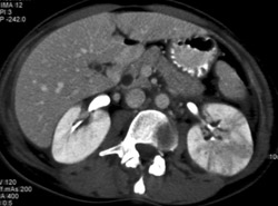 Acute Pyelonephritis - CTisus CT Scan