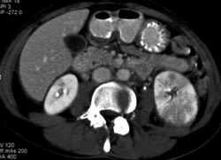 Acute Pyelonephritis - CTisus CT Scan