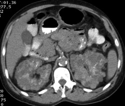 Polycystic Kidneys With Area of Hemorrhage - CTisus CT Scan