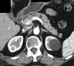 Simple Cyst - CTisus CT Scan