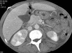 Acute Pyelonephritis - CTisus CT Scan