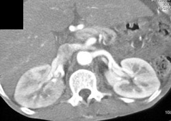 Acute Pyelonephritis - CTisus CT Scan