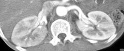 Acute Pyelonephritis - CTisus CT Scan