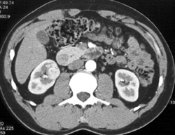 2 Cm Right Renal Cell Carcinoma - CTisus CT Scan