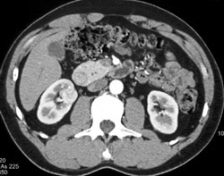 Right Renal Cell Carcinoma Best Seen on Venous Phase - CTisus CT Scan