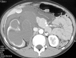 Injured Renal Ureteropelvic Junction (UPJ) S/P MVA - CTisus CT Scan