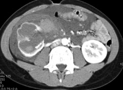 Urine Leak and Trauma to Right Ureteropelvic Junction (UPJ) - CTisus CT Scan