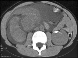 Blood Mixes With Extravasated Contrast - CTisus CT Scan