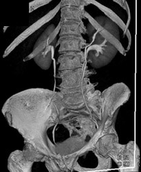 Duplicated Collecting System - CTisus CT Scan