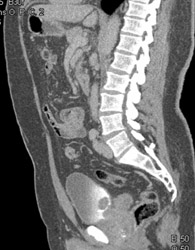 Bladder Cancer - CTisus CT Scan