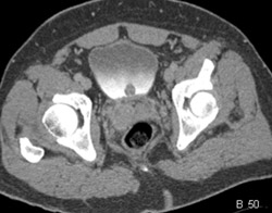 Bladder Cancer - CTisus CT Scan