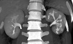 Papillary Necrosis on the Left - CTisus CT Scan