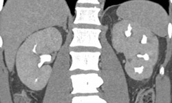 Papillary Necrosis - CTisus CT Scan