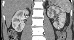 Differential Function With Decreased Left Nephrogram - CTisus CT Scan