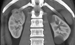 Renal Cell Carcinoma - CTisus CT Scan