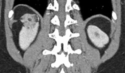 Renal Cell Carcinoma - CTisus CT Scan