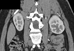 Ureteropelvic Junction (UPJ) on the Left - CTisus CT Scan