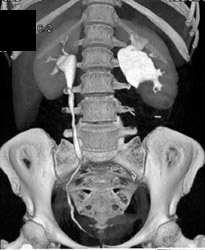 Ureteropelvic Junction (UPJ) Due to Focal Narrowing of Ureter - CTisus CT Scan