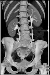 Normal CT Urogram - CTisus CT Scan