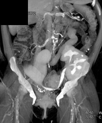 Pelvic Kidney and Neobladder - CTisus CT Scan