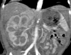 Renal Vein Thrombosis in A Newborn - CTisus CT Scan