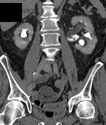 Filling Defects in A Left Renal Pelvis C/w Transitional Cell Cancer (TCC) - CTisus CT Scan