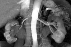 Transitional Cell Cancer (TCC) of Left Renal Pelvis - CTisus CT Scan