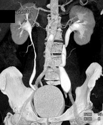 Ct Urogram With Dilated Left Ureter - CTisus CT Scan