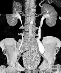 Dilated Ureters on CT Urogram - CTisus CT Scan