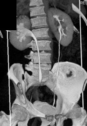 Crossing Vessel By Distal Right Ureter - CTisus CT Scan