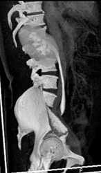 Dilated Ureter Due to Crossing Vessel - CTisus CT Scan