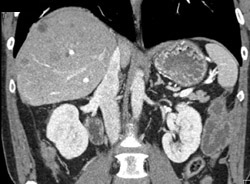 Implants Near Right Kidney. Liver Metastases Also Present - CTisus CT Scan